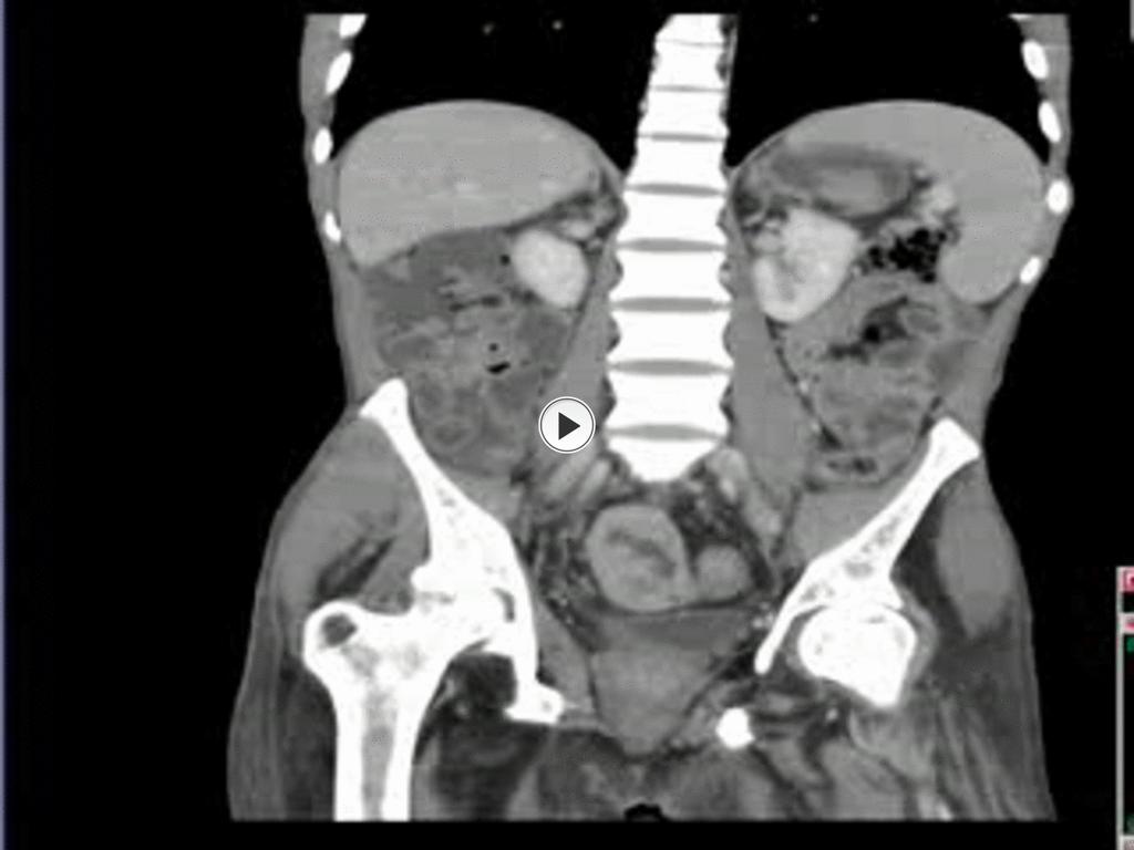 Fig. 14: GIST in a patient with