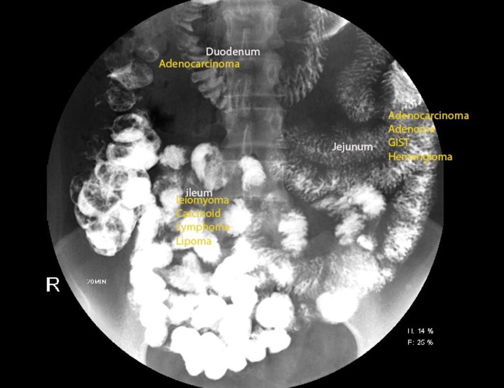 Multifocal- lymphoma, carcinoid, metastasis to small bowel, peutz jeghers polyps. ( Fig. 20 on page 15, Fig.