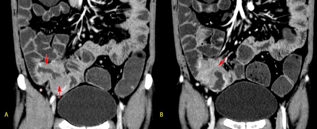 Mutidetector CT axial and coronal images shows short segment circumferential
