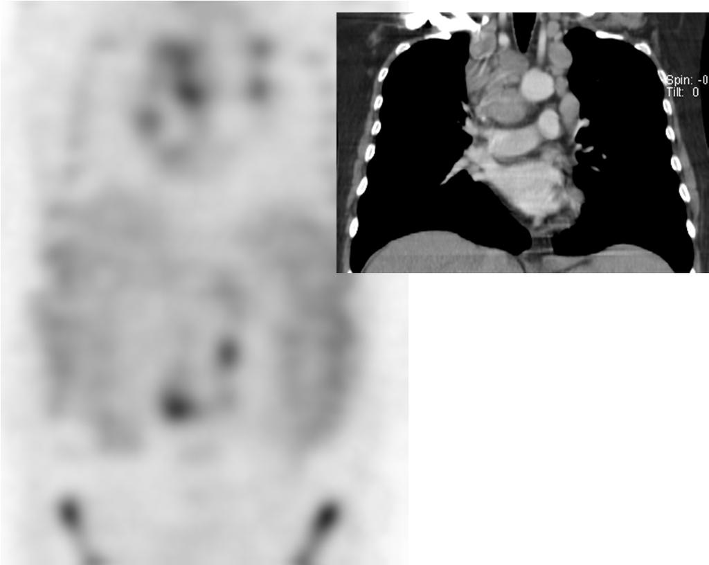 Coronal images show the most active paratracheal lymph nodes bilaterally and the right interlobar region.
