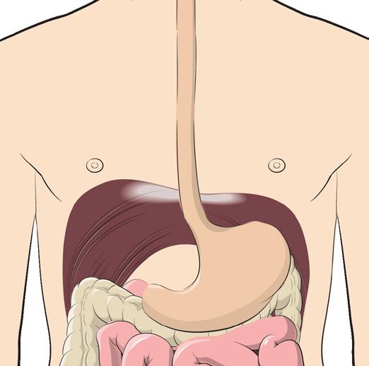 The Conditions: GERD, Hiatal Hernia Gastroesophageal reflux disease or GERD is a common digestive disease that occurs when stomach acid flows back into your esophagus and irritates the lining.