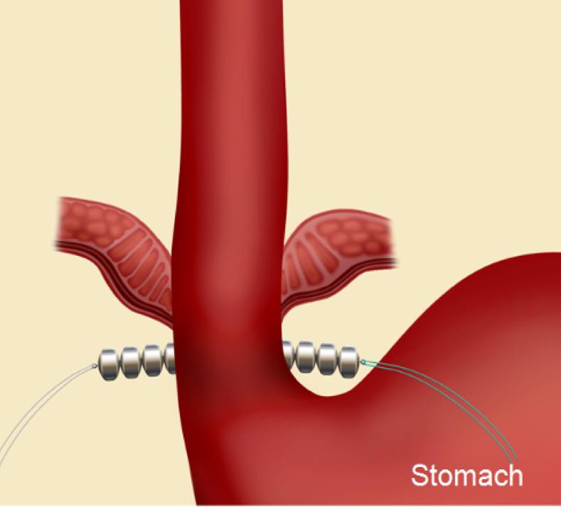 10 What happens before the treatment? You will need to have several tests to make sure you are healthy enough for the surgery and to assess your esophagus. Your doctor will explain these tests to you.