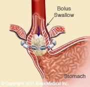 Stomach juices reflux into the esophagus and may injure the esophagus and cause symptoms of heartburn or