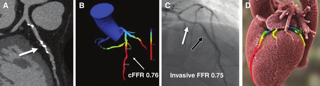 Figure 6 Figure 6: Example of coronary stenosis at coronary CT angiography and ICA with corresponding and invasive FFR measurement.