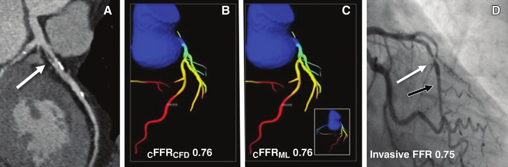 Figure 3 Figure 3: Example of coronary stenosis at coronary CT angiography and ICA with corresponding using computational fluid dynamics ( c FFR CFD ) and machine learning ( c FFR ML ) compared with
