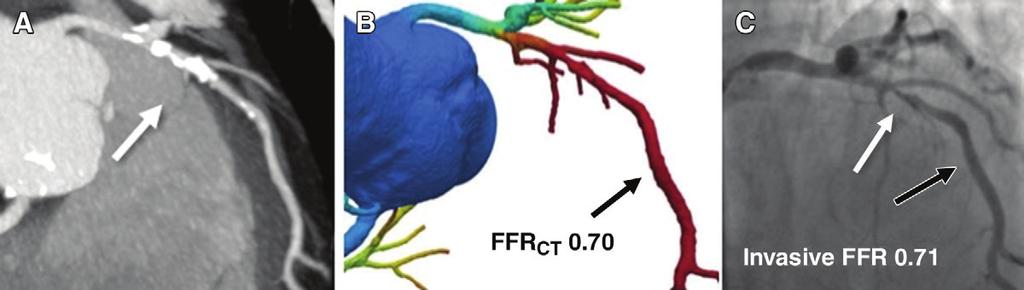 Figure 4 Figure 4: Example of coronary stenosis at coronary CT angiography and ICA with corresponding and invasive FFR measurement.