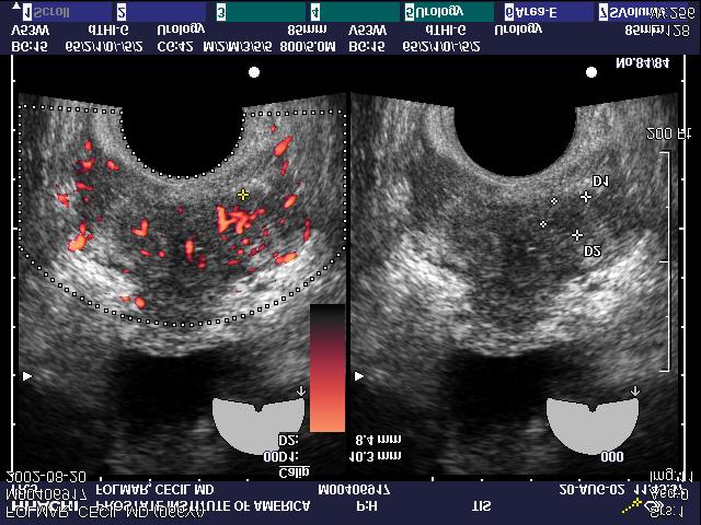 The Color-Doppler image (at the left) clearly shows a small focal area of increased blood flow.