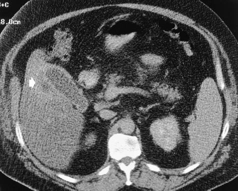 represent gallstones (arrow). Note the subtle pericholecystic inflammation. a. b. Figure 15. Hepatic abscess related to acute cholecystitis.
