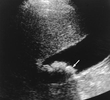RG Volume 20 Number 3 Bortoff et al 761 a. b. Figure 16. Gallstone pancreatitis in a 20-year-old woman with no history of alcohol abuse.