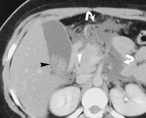 The pancreas and CBD are poorly visualized. US is commonly performed in this setting to evaluate for gallstones as a possible cause of pancreatitis.