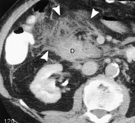The patient underwent cholecystectomy and has been symptom free for over 1 year. a. b. Figure 17. Acute cholecystitis and duodenitis.
