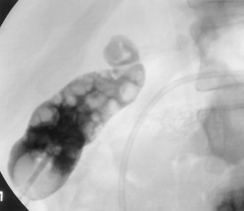 RG Volume 20 Number 3 Bortoff et al 765 a. Figure 23. Cholecystostomy and percutaneous stone removal in an elderly patient whose condition was too unstable for cholecystectomy.