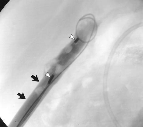 (a) Oblique percutaneous cholecystogram obtained after injection of contrast material via the catheter shows multiple filling defects consistent with gallstones.