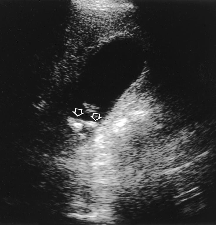 (b) Oblique US scan obtained after repositioning the patient shows mobility of the gallstones (arrows).