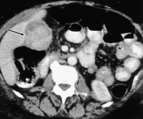 (4) Gallbladder masses that should not be confused with gallstones at US.