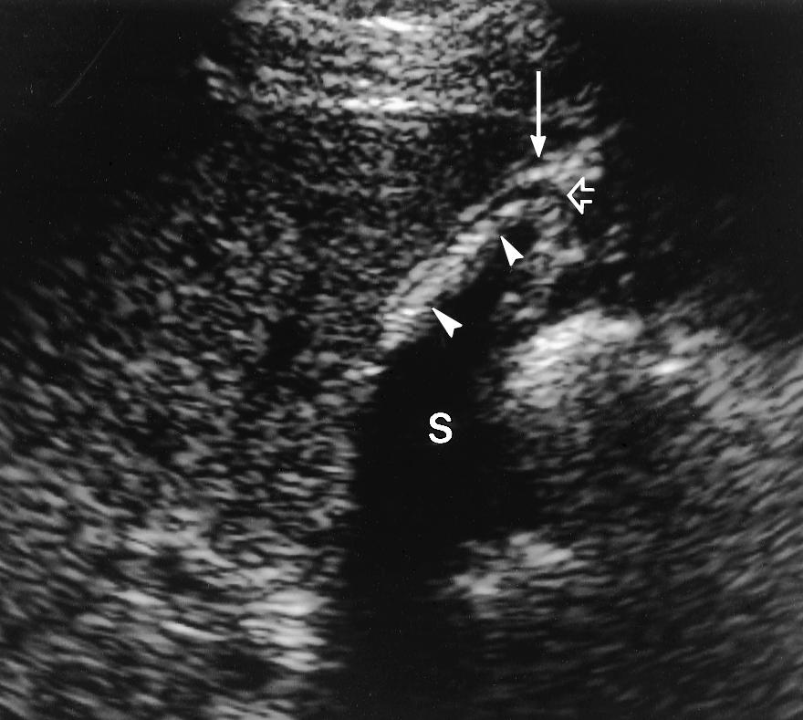 (a) Frontal upper right spot image from initial oral cholecystography shows bowel gas superimposed over the lower aspect of the gallbladder.