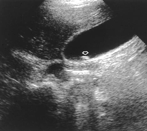 There was maximum tenderness during compression with the transducer directly over the gallbladder, a positive Murphy sign. (8) Acute cholecystitis.