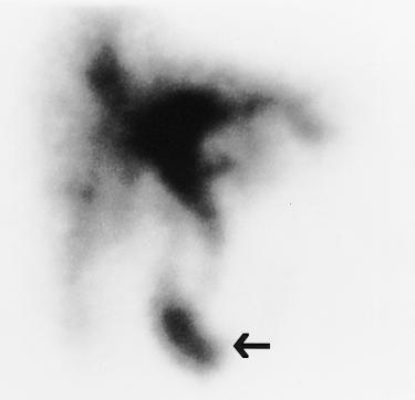 Diagnostic considerations included adherent calculi and cholesterol crystals or polyps. Cholescintigraphy was recommended.