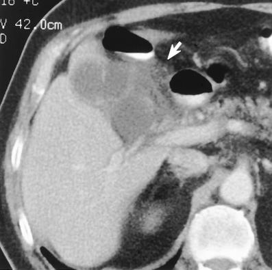 (b) CT scan obtained soon afterward shows a normalappearing gallbladder.