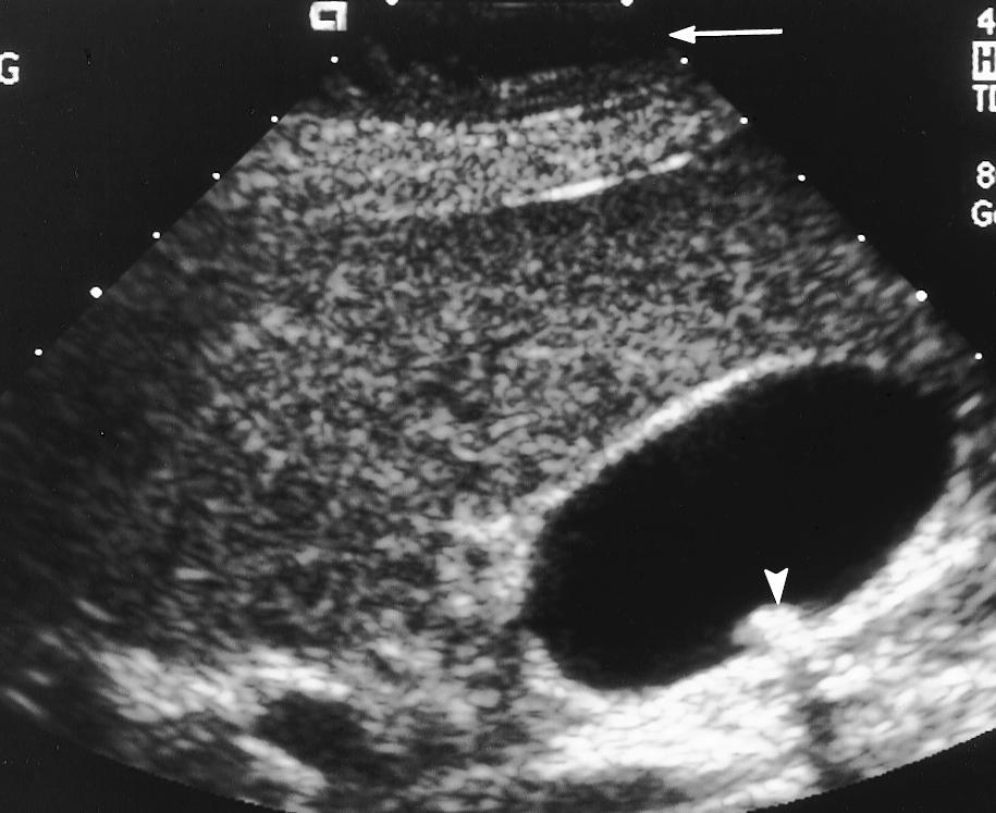 Review of the US scan (a) revealed a superficial hypoechoic mass at the top of the image (arrow), a finding that corresponds to the hematoma. The patient s symptoms abated when the hematoma resolved.