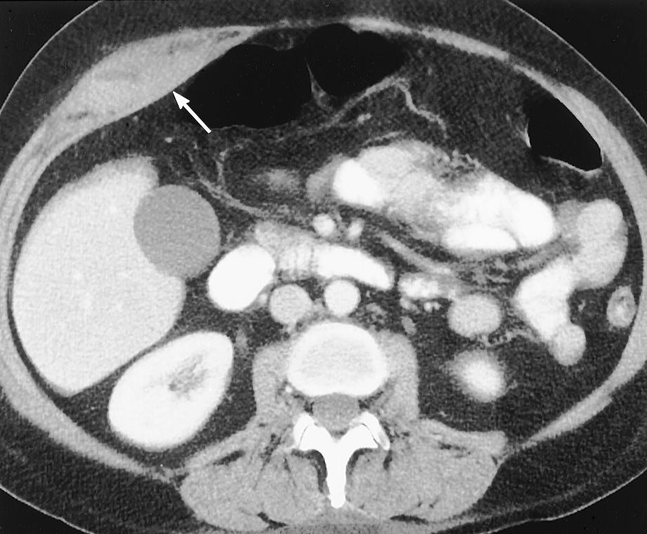 (a) CT scan obtained at the level of the gallbladder shows cholelithiasis (arrowhead), poor definition of the gallbladder wall, and subtle pericholecystic inflammation (arrows).