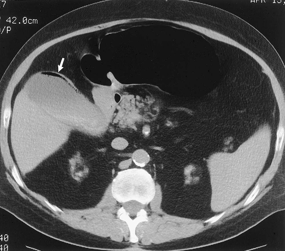 (b) CT scan obtained in another patient shows air within the gallbladder wall and the gallbladder lumen (arrow). Figure 11.