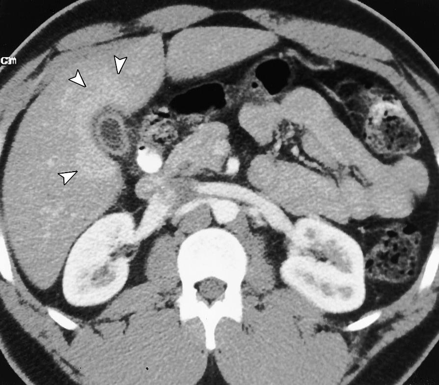 Contrast material enhanced CT scan shows increased hepatic attenuation adjacent to the gallbladder (arrowheads). Note the thickening of the gallbladder wall.