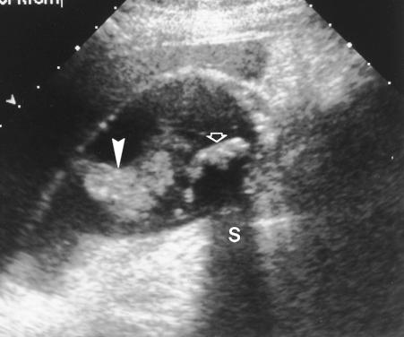 Complications of acute cholecystitis include the following: (a) Emphysematous cholecystitis is characterized by gas-forming organisms, which cause gas to collect in the wall and lumen of the