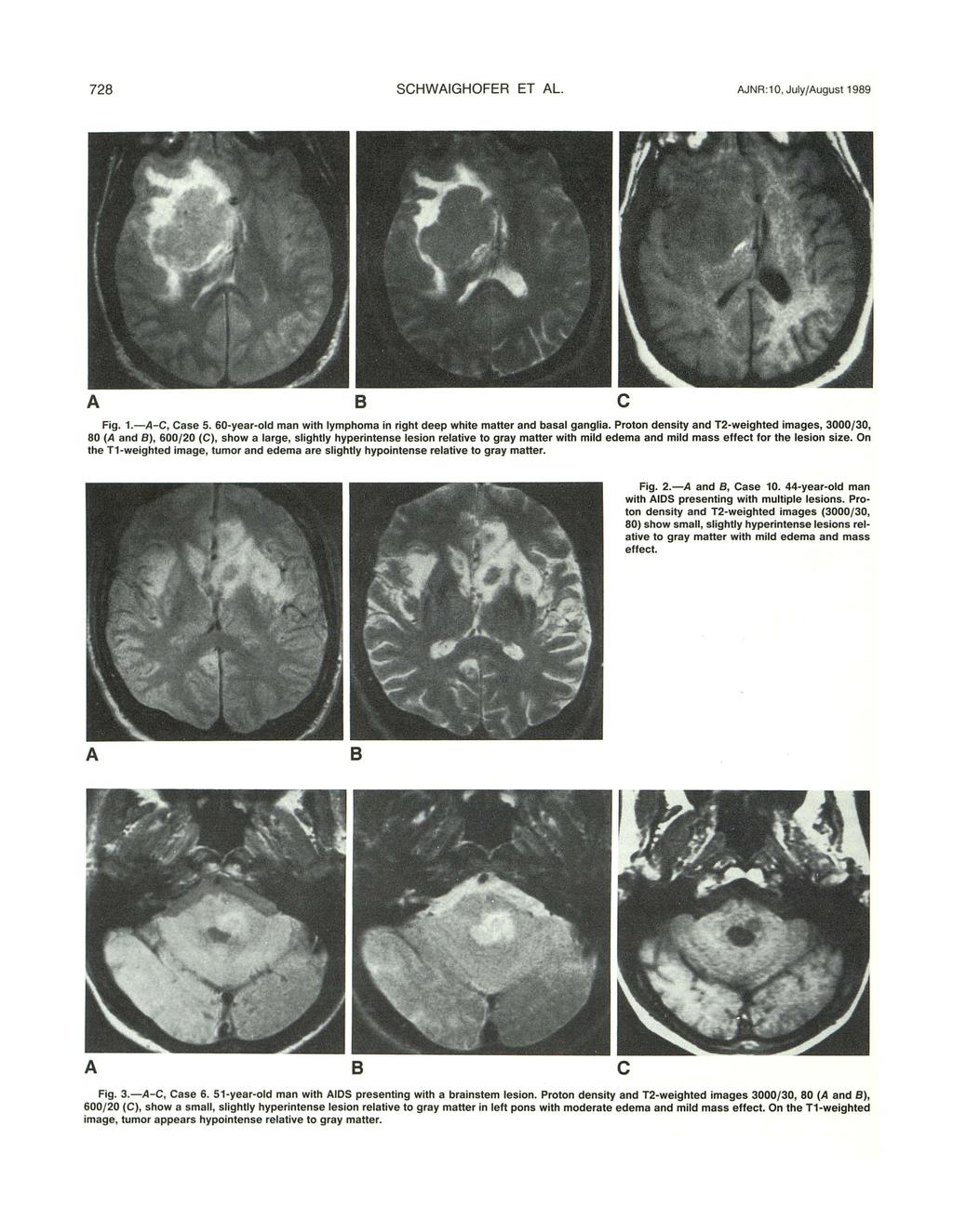 728 SCHWAIGHOFER ET AL AJNR:1 0, July/August 1989 A B c Fig. 1.-A- C, Case 5. 60-year-old man with lymphoma in right deep white matter and basal ganglia.