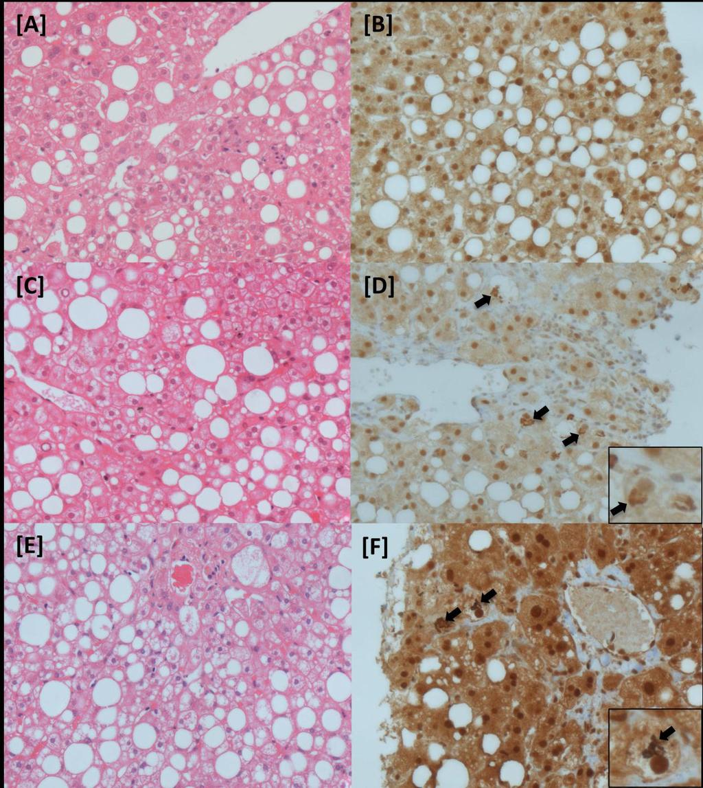 Figure 4-2. Histological inclusion criteria for LEAN trial. Liver biopsy sections (actual magnification 400X).