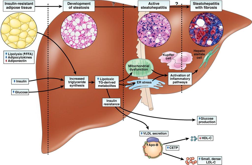 Figure 1-2. Proposed mechanism for the role adipose tissue dysfunction in NAFLD (Cusi, 2012).