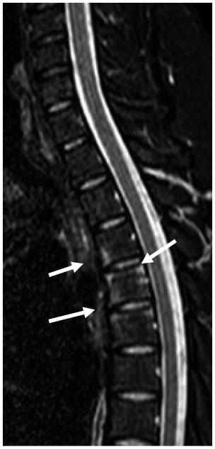 Evidence for whole-spine MRI but have limitations.