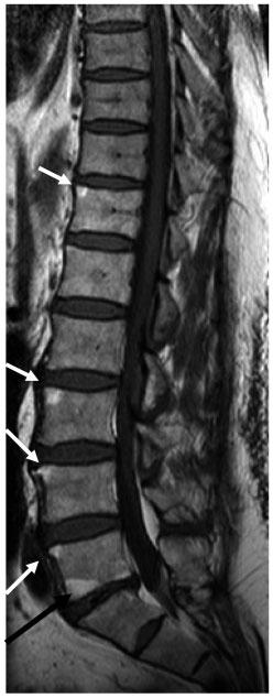 Evidence for whole-spine MRI lesion (LR = 14.5) or 53 inflammatory RLs (LR = 12.4) on spinal MRI, then that patient has definite axial-spa (post-test probability = 95%) [21].