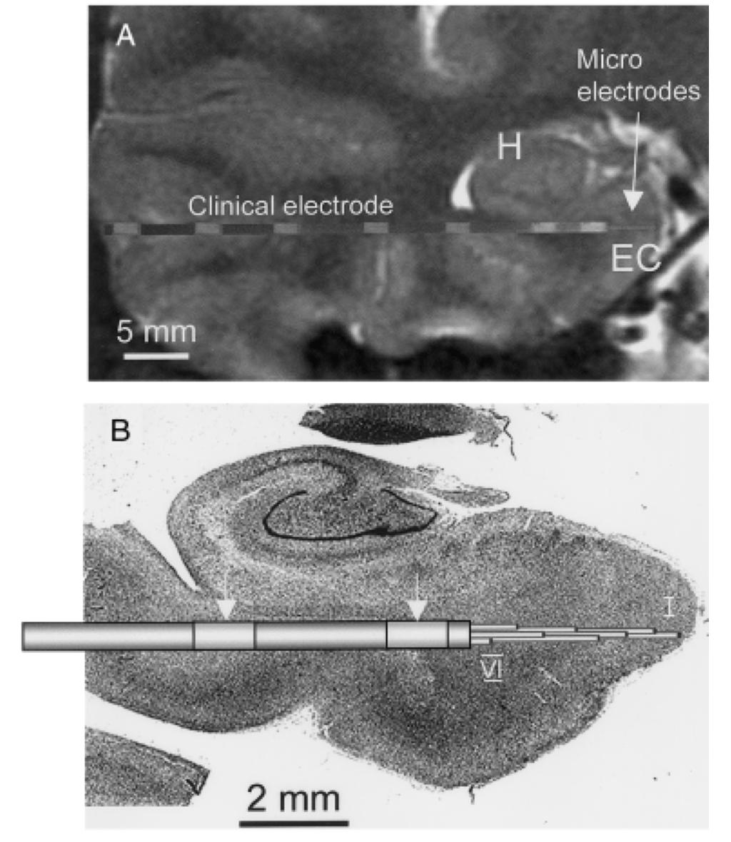 HFOs in humans Photo of microelectrode Bragin et al.