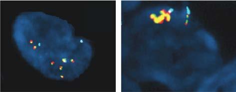 1. Representative images obtained from patients show a copy-number gain in PDL1 and PDL2 (Panel B, left), with six greenred (yellow overlap) signals (signifying a fusion signal), as compared with