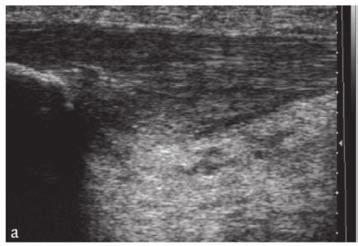 20 Chapter 2 Figure 2.2. Ultrasound characteristics of patellar tendinopathy: (a) thickened