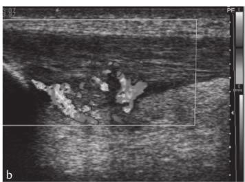 neovascularisation in the tendon. Figure 2.3.