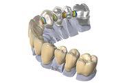 Wide range of indications Already the standard version, ORIGIN Intelligence HD covers a wide variety of indications: Anatomical Crowns Full contour modeling has always been ORIGIN Intelligence HD 's