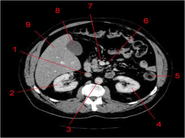 1. Inferior vena cava 2. Right Kidney 3. Aorta 4. Left Kidney 5. Left colon 6. S. mesenteric artery 7. S. mesenteric vein 8. Gallbladder 9.