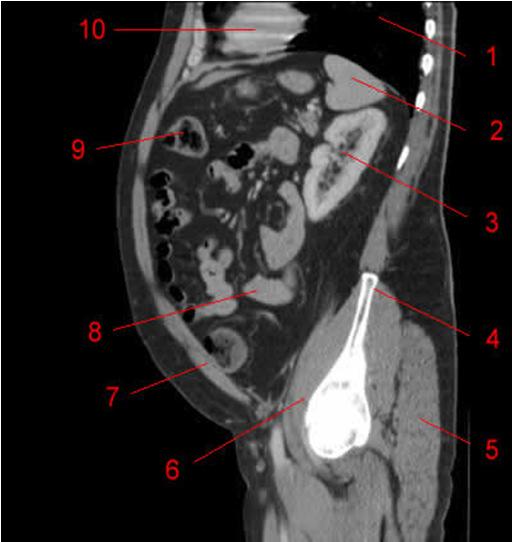 Sagittal 1. Left lung 2. Spleen 3. Left kidney 4. Iliac wing 5. Gluteus maximus muscle 6. Iliac muscle 7. Rectus abdominis muscle 8. Small bowel 9.