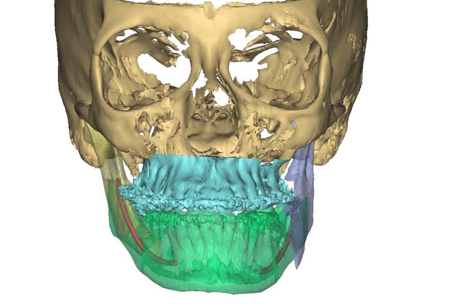 Surgical Plan End Position Mandible shown in