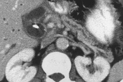 and C, Contrast-enhanced CT of abdomen in 58-year-old man with history of alcohol abuse who presented with jaundice.