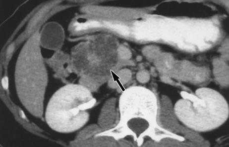 , Noncontrast CT scan was obtained because of renal compromise.
