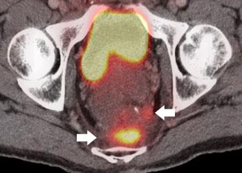 Liver Metastases Sixty percent of patients with colorectal cancer will develop liver metastases. If left untreated, the median survival is 6-12 months with no survival beyond 5 years.