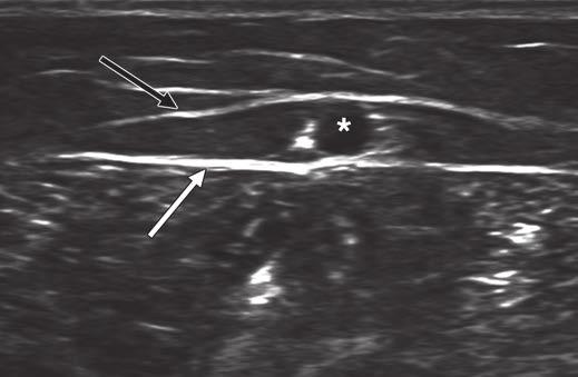 3 Axial ultrasound images of great saphenous vein (A) and small saphenous vein (B) in saphenous compartment