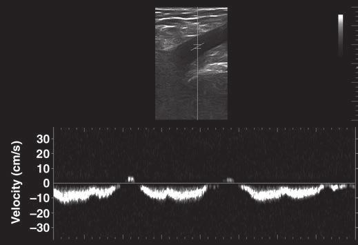 Chronic Venous Disease of the Lower Extremities A B A Fig. 8 Pulsed-wave Doppler tracing.