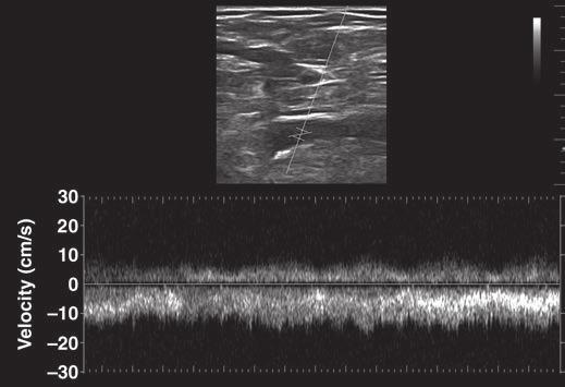B and C, Pulsed-wave Doppler tracings in prior left iliofemoral deep venous thrombosis show left common