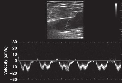 Right common femoral vein waveform (C) shows respiratory and cardiac variability.
