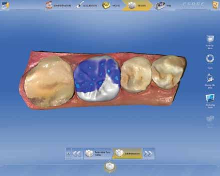 CEREC SOFTWARE Streamlined and intuitive restoration design process From start to