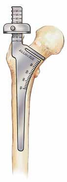 Gauge Acetabulum Sizing of the acetabulum is conducted by using provisional shells that are attached to the gauge handle (Figure 4).
